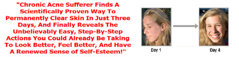 Chronic Acne Sufferer Finds a Scientifically Proven Way to Permanent Clear Skin in just Thre Days